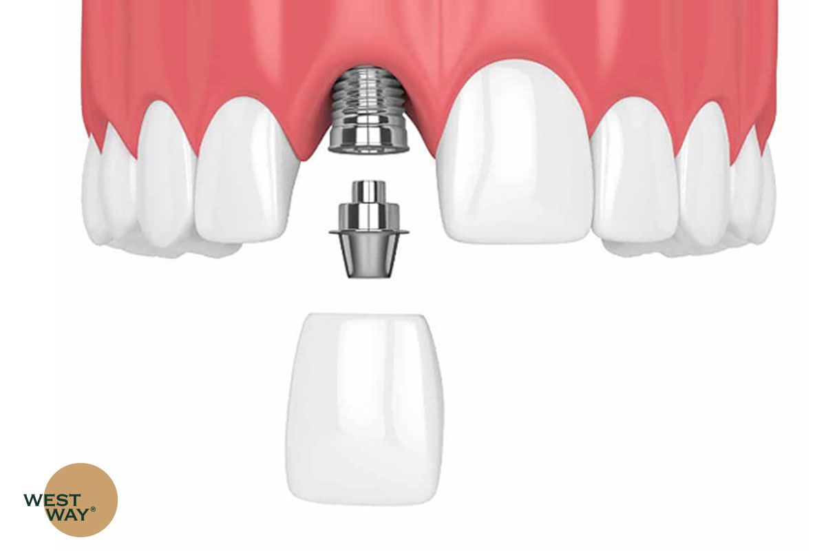 Phương pháp nào tối ưu nhất để khắc phục việc mất răng cửa?